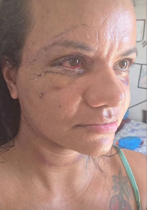 Juliana Soares, de 35 anos, após cirurgia para reconstrução do rosto.