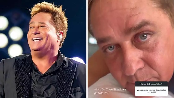 Leonardo foi submetido à cirurgia plástica para corrigir pálpebras