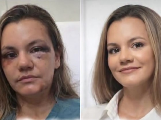 Mulher agredida com 61 socos pelo namorado mostra resultado de reconstrução facial.