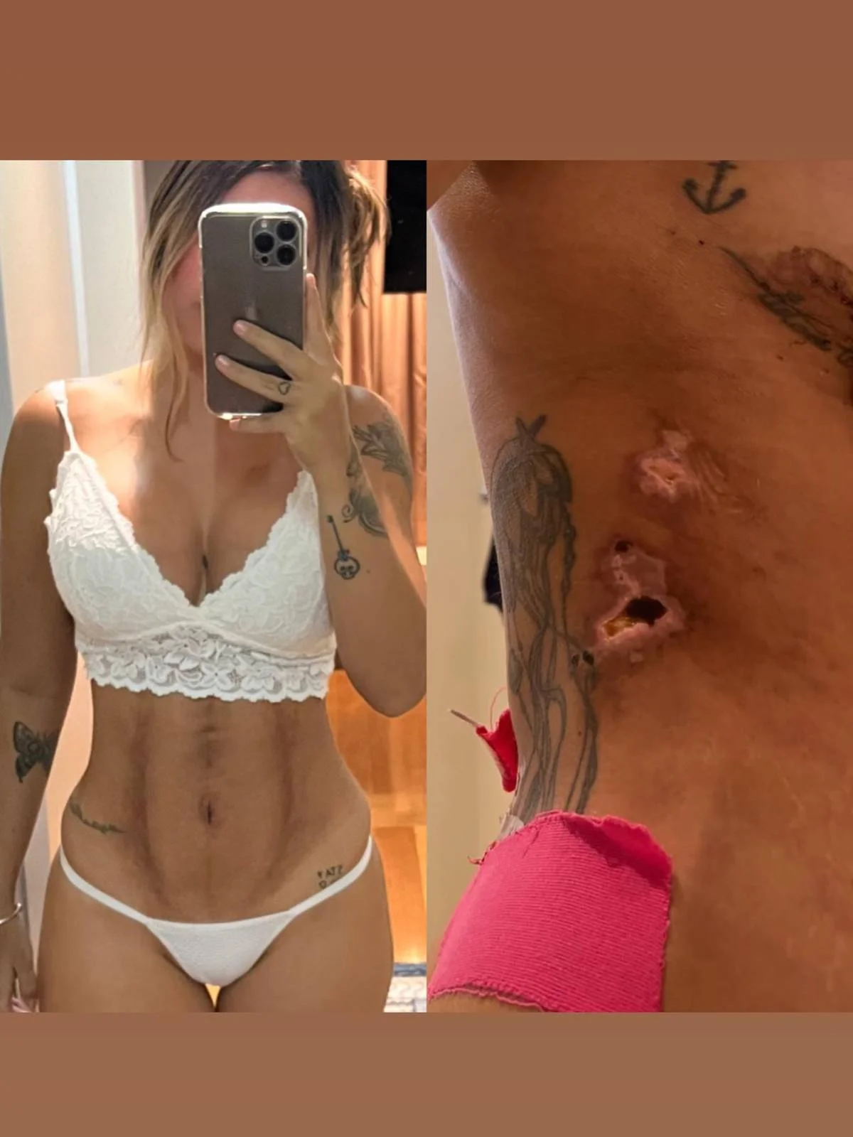 Corpo deformado e torto, necrose, barriga queimada, falta de assistência e psicológico abalado são apenas alguns dos exemplos que a influenciadora digital Mariana Tavares usou para descrever o que aconteceu com ela após realizar uma cirurgia de Lipo LAD na Clínica JK Estética Avançada